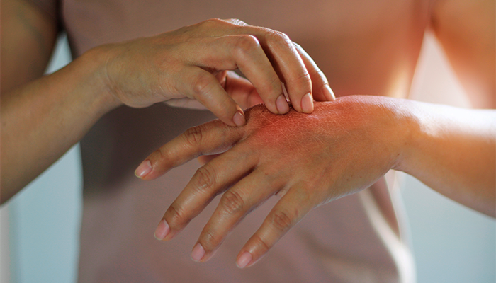 Fotografía para artículo sobre los tipos de dermatitis y tratamientos más comunes, para el blog de topfarma.